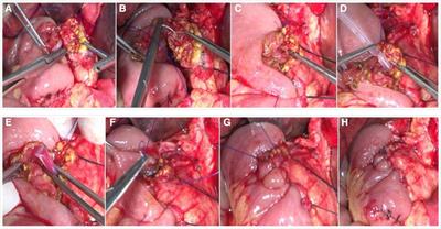 Novel end-to-side one-layer continuous pancreaticojejunostomy vs. end-to-end invaginated pancreaticojejunostomy in pancreatoduodenectomy: A single-center retrospective study